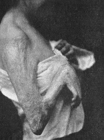 Fig. 107.—Contracture of Elbow and Wrist following a burn in childhood. Treated by resection of both joints, and the insertion, on the palmar aspect of each, of a flap from the abdominal wall.