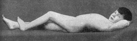 Fig. 110.—Disease of Left Hip: position of ease assumed by patient, showing moderate flexion and lordosis.